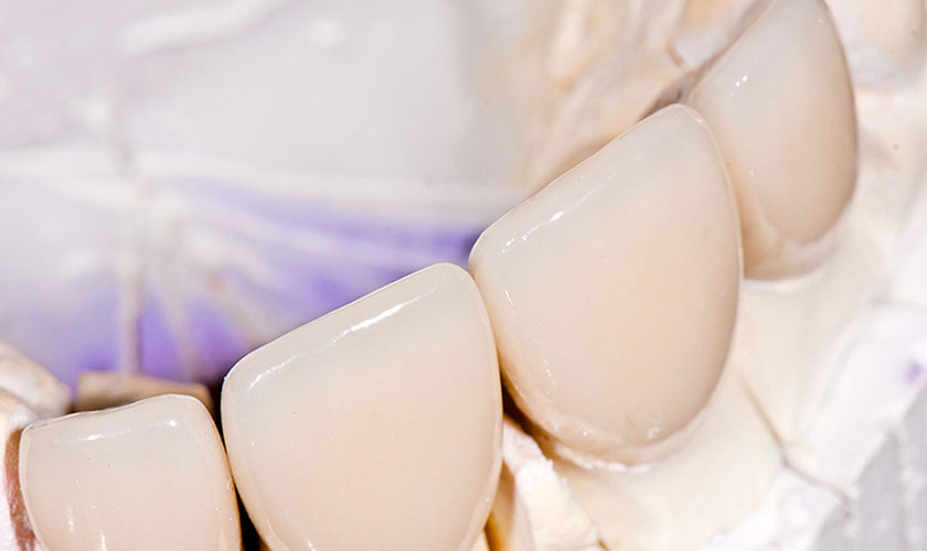 Cách bảo quản răng sứ Cercon ảnh hưởng lớn đến tuổi thọ của răng sứ Cercon