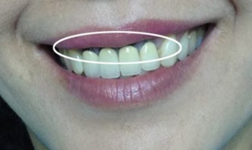 Răng bị hở tại chân răng sau khi bọc răng sứ 