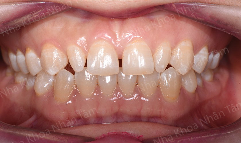 Răng bị nhiễm màu nặng nên bọc răng sứ để khôi phục thẩm mỹ