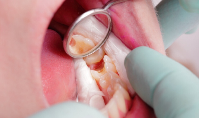 Răng bị chết tủy rất giòn, dễ vỡ nên cần bọc răng sứ