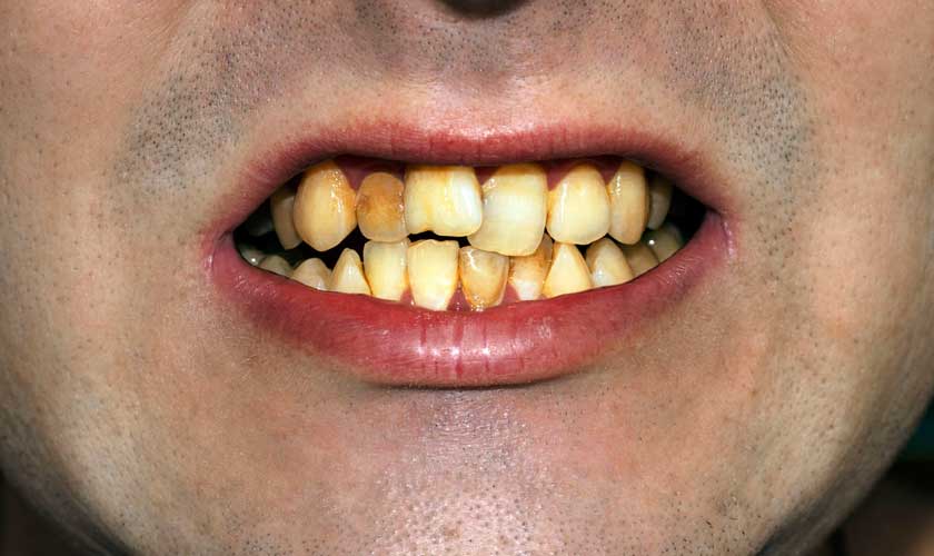 Răng ố vàng ảnh hưởng nghiêm trọng đến thẩm mỹ