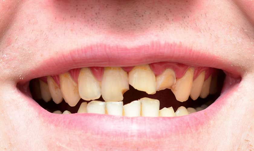 Răng ố vàng làm tăng nguy cơ mắc các bệnh lý răng miệng