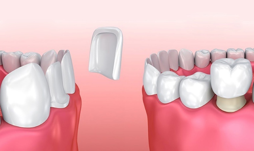 Phương pháp dán sứ Veneer và bọc răng sứ thẩm mỹ