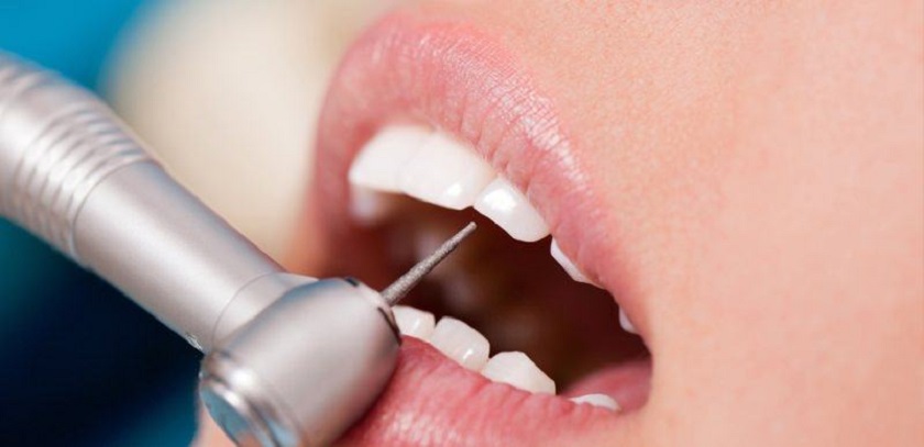 Phục hình răng sứ là kỹ thuật có tính an toàn cao