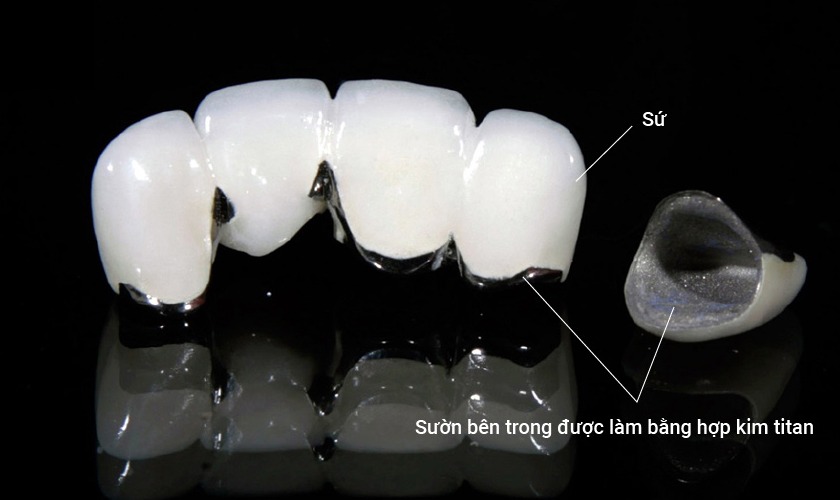 Ưu điểm bọc răng sứ Titan là bền, chắc, chịu lực tốt