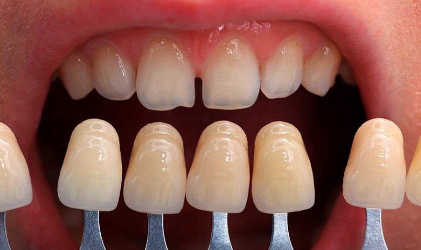 Quy trình và cách bảo quản sau khi bọc răng sứ cho răng thưa