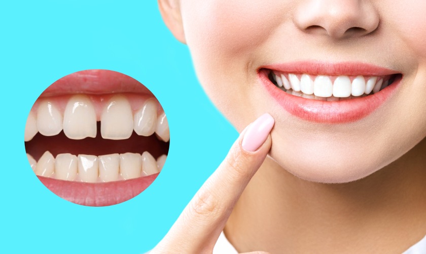 Bọc răng sứ cho răng thưa