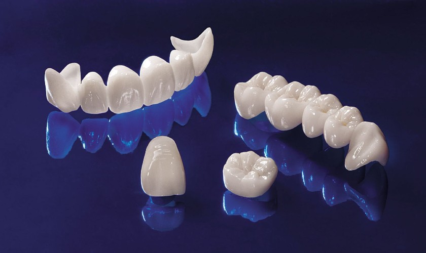 Răng sứ Cercon được bao phủ toàn sứ màu sắc đẹp tự nhiên