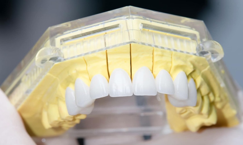 Răng sứ Cercon HT sở hữu nhiều ưu điểm vượt trội