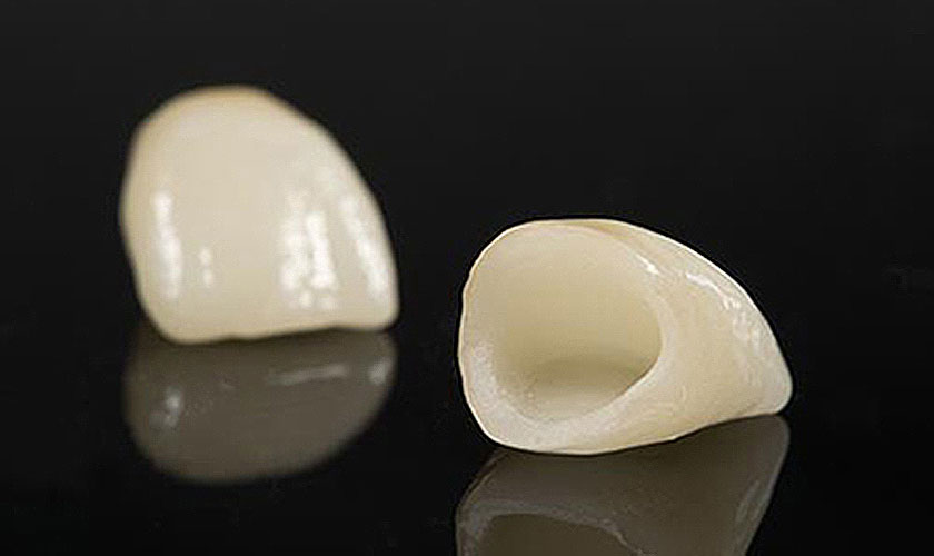 Nhược điểm răng sứ Cercon ht là chi phí cao và dễ lộ ổ chân răng