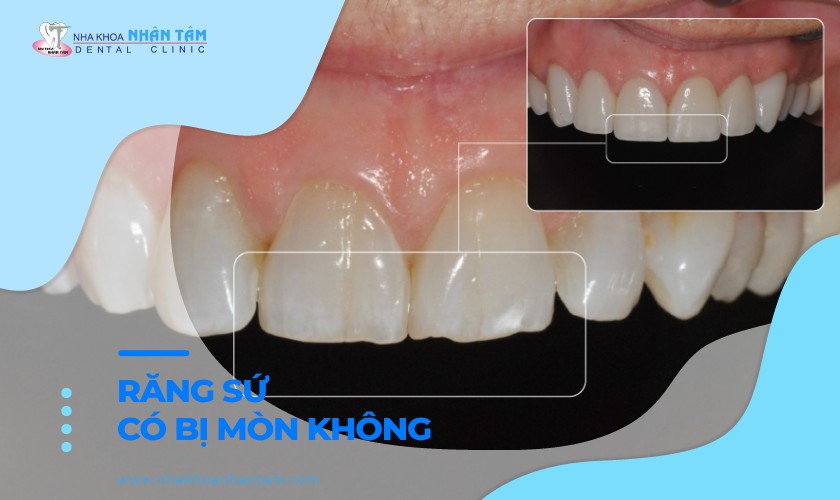 Răng sứ có bị mòn theo thời gian không?