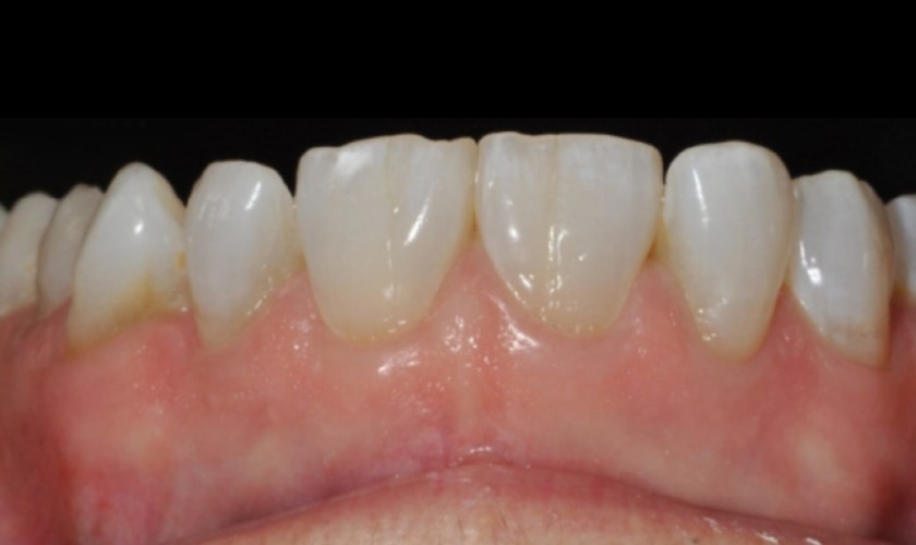 Giống như răng tự nhiên, răng sứ cũng có thể bị mòn theo thời gian