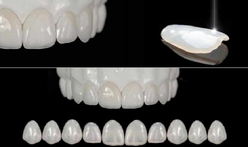 Răng sứ có mấy loại? Đặc điểm của từng loại ra sao?