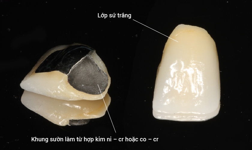 Có nên bọc răng sứ kim loại? Ưu nhược điểm như thế nào?