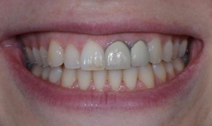 Lâu ngày, răng sứ Titan sẽ làm đen viền nướu