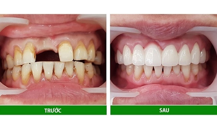 Răng sứ titan thẩm mỹ, tuổi thọ trên 5 năm