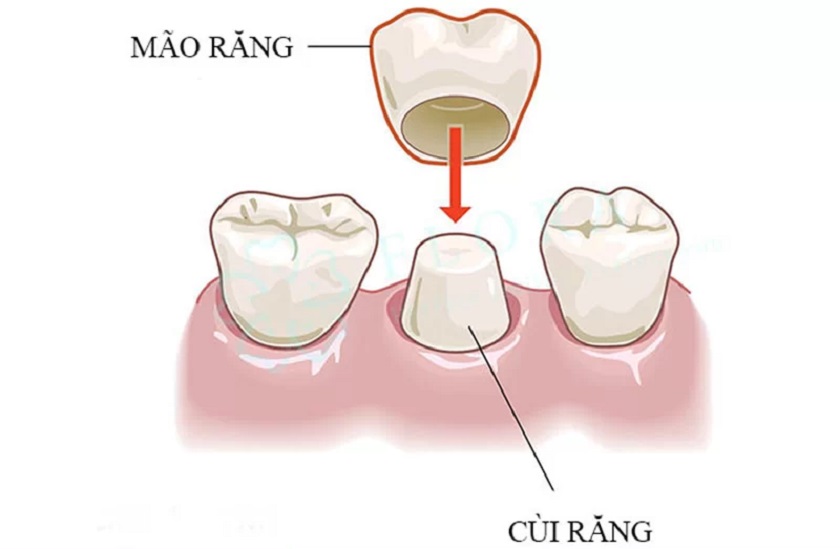 Kỹ thuật bọc răng sứ thẩm mỹ