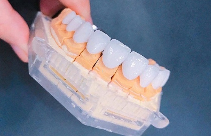 Bọc răng sứ có ảnh hưởng gì tới sức khỏe không?