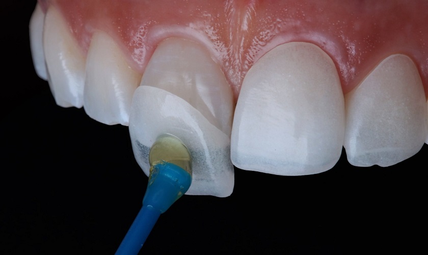 Nguyên liệu chính sử dụng để sản xuất răng sứ lisi là gì?