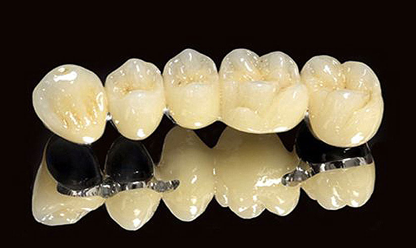 Răng sứ titan an toàn với người sử dụng hơn răng sứ thường