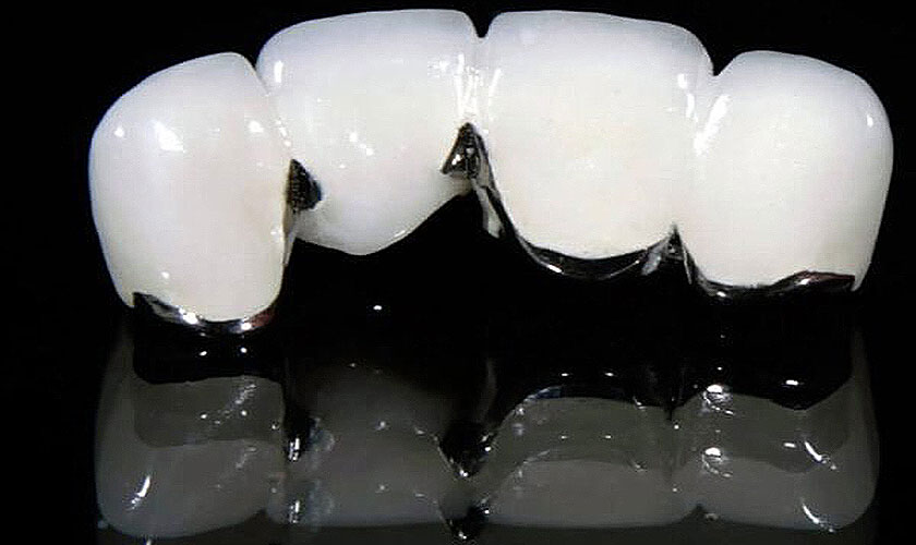 Chọn răng sứ thường hay răng sứ Titan: nha khoa Nhân Tâm xin trả lời rằng nên chọn răng sứ titan