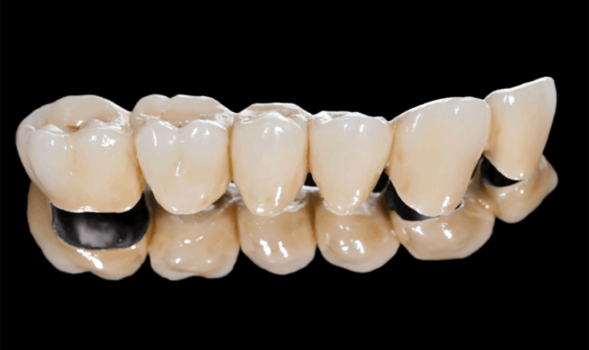 Đối tượng trồng răng sứ Titan