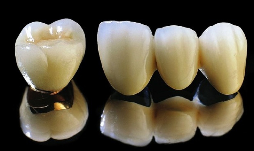 Cách chăm sóc và bảo quản răng sứ titan?
