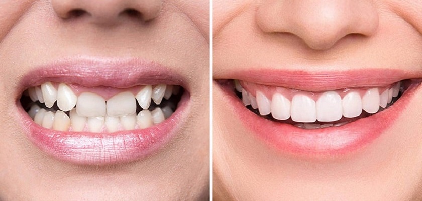 Răng sứ toàn sứ đem lại nhiều ưu điểm tuyệt vời