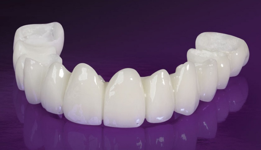 Sản phẩm răng sứ Cercon