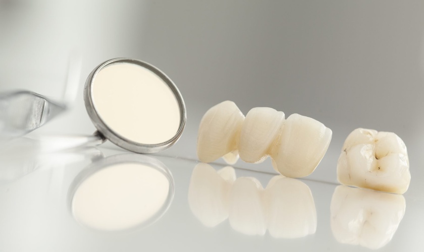 Răng toàn sứ là gì? Ưu điểm vượt trội của răng toàn sứ