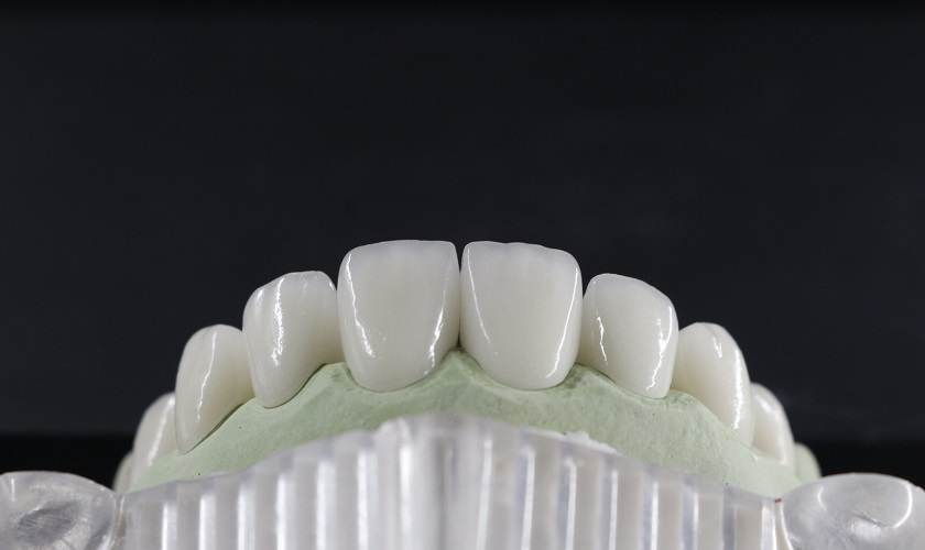 Răng sứ Zirconia có màu trắng tự nhiên như răng thật