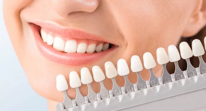 Bảng màu răng toàn sứ Zirconia