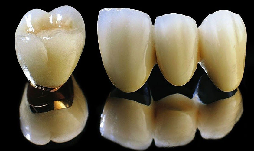 Quy trình làm răng sứ và răng titan được thực hiện giống nhau