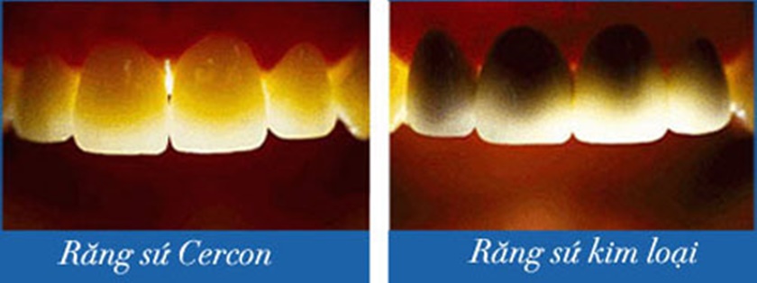 Sự khác biệt giữa răng sứ Cercon và răng sứ kim loại