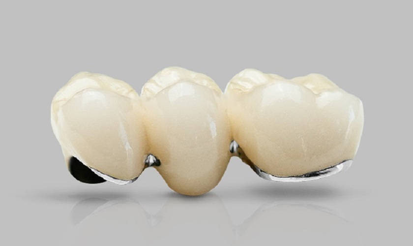 Răng sứ Titan sử dụng được bao lâu và cách bản quản thế nào?