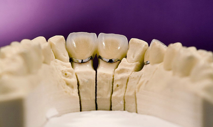 Hãy liên hệ nha khoa Nhân Tâm để được biết bọc răng sứ bao nhiêu cho trường hợp của bạn.