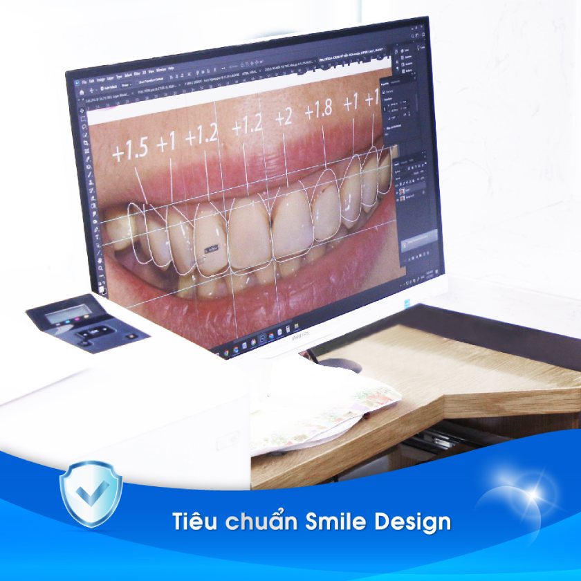 Tiêu chuẩn Smile Design