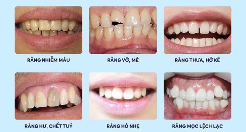 Các trường hợp nên bọc răng sứ