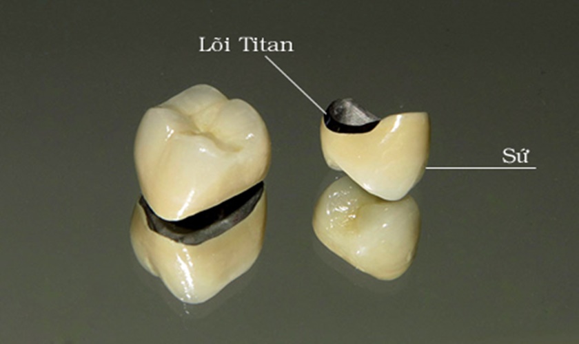 Tìm hiểu về quy trình làm mão răng sứ Titan