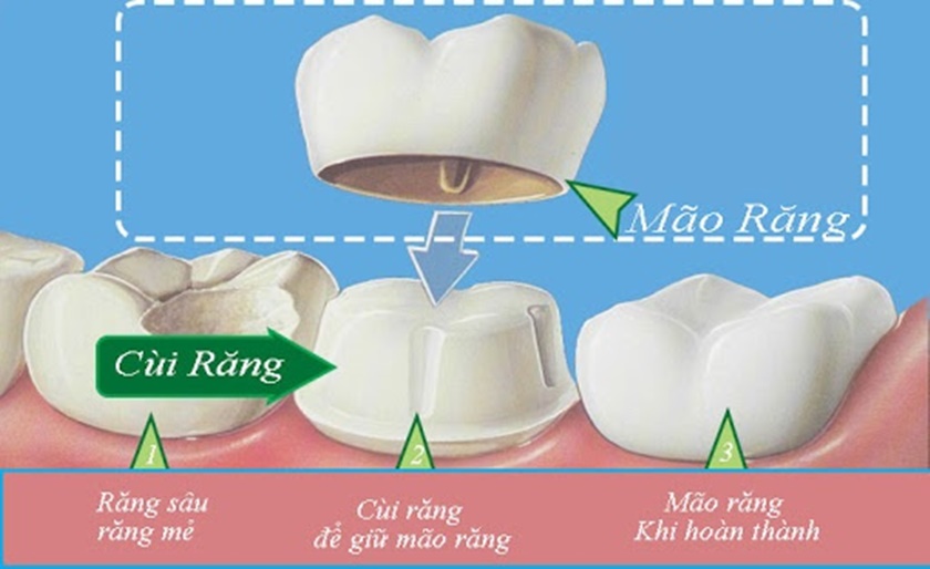 Mão răng sứ Titan là một chiếc áo bảo vệ cho răng bị hư hỏng nặng