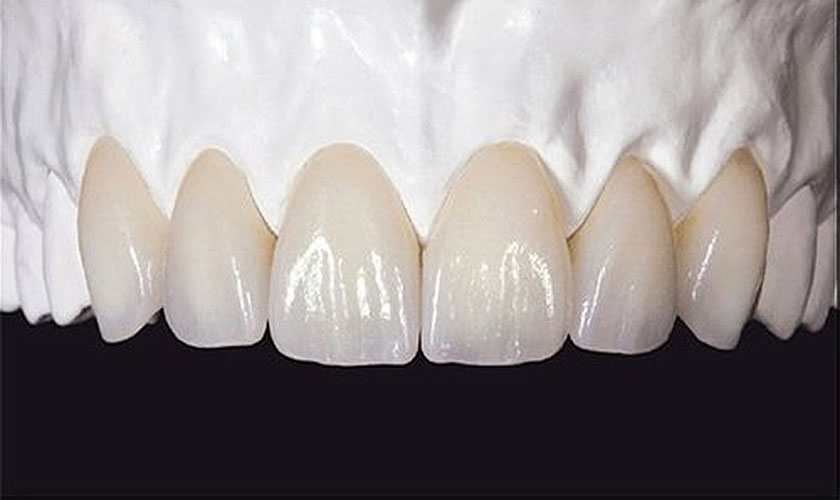 Ưu điểm răng sứ là khắc phục được nhược điểm của răng sứ titan