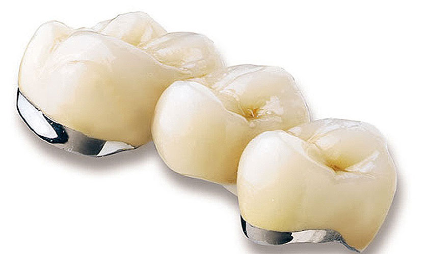 nên chọn răng sứ hay răng Titan cần cân nhắc chi phí thực hiện và vị trí bọc răng.