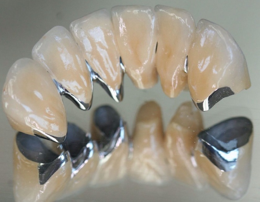 Ưu điểm răng sứ Titan là cứng chắc, chịu lực tốt và tương đối an toàn với người dùng