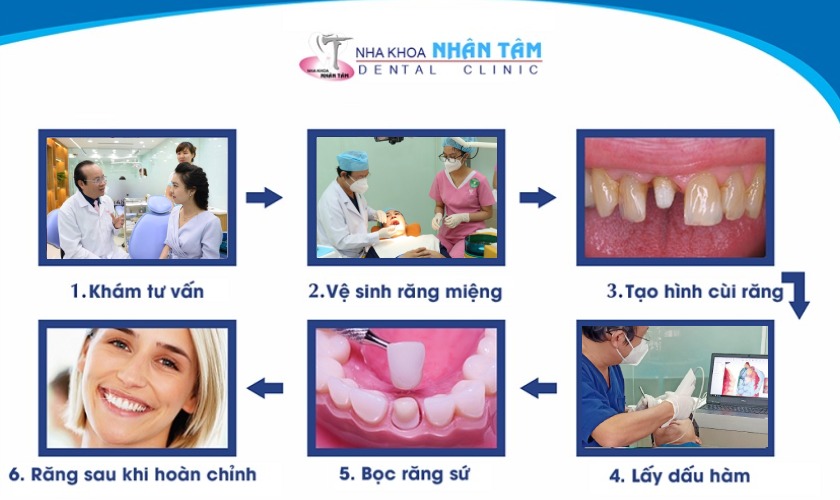 Quy trình trồng răng sứ tại Nha khoa Nhân Tâm