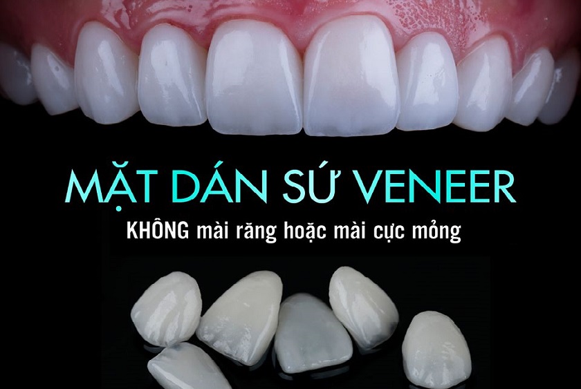 Mặt dán sứ siêu mỏng Veneer hạn chế mài răng đến mức tối thiểu