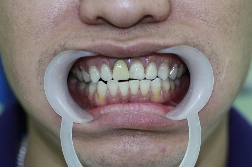 Hiện tượng đen viền nướu khi trồng răng sứ kim loại