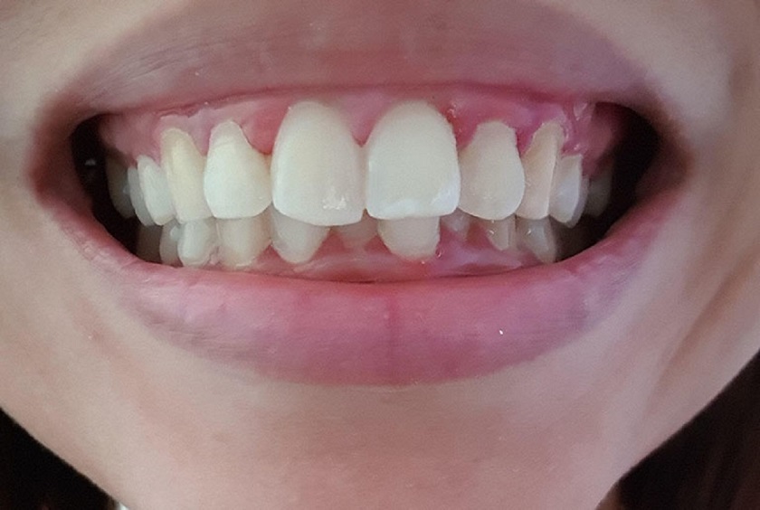 Răng cửa bị hô nhẹ