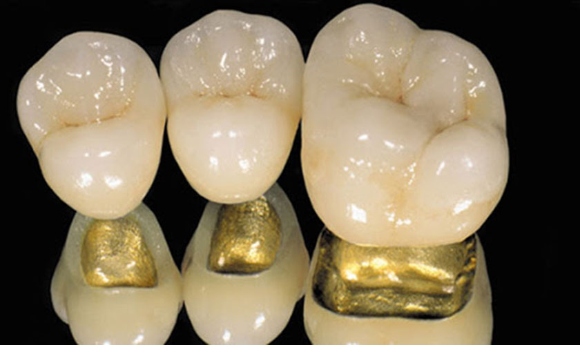 Quy trình làm răng sứ Titan được thực hiện hiệu quả cần có bác sĩ giàu kinh nghiệm