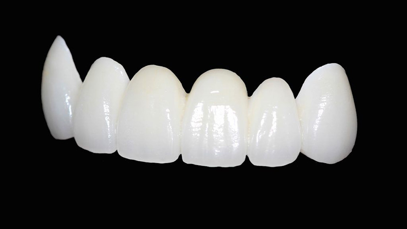 Quy trình làm răng sứ Zirconia cần thực hiện đúng và đủ để đảm bảo kết quả được thành công nhất