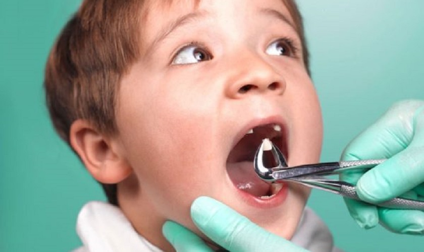 Răng sữa lung lay bao lâu thì nhổ? Lưu ý sau khi nhổ răng sữa